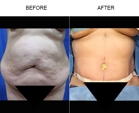 How Long Does It Take To Recover From Lipo 360? - GA Fashion